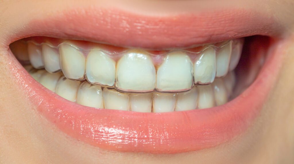 Invisalign Sorrento Valley Invisalign in San Diego