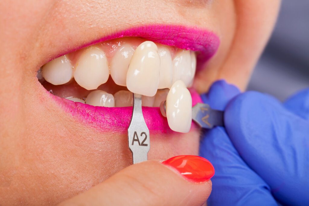cosmetic dentist Torrey Pines veneers in Sorrento Valley